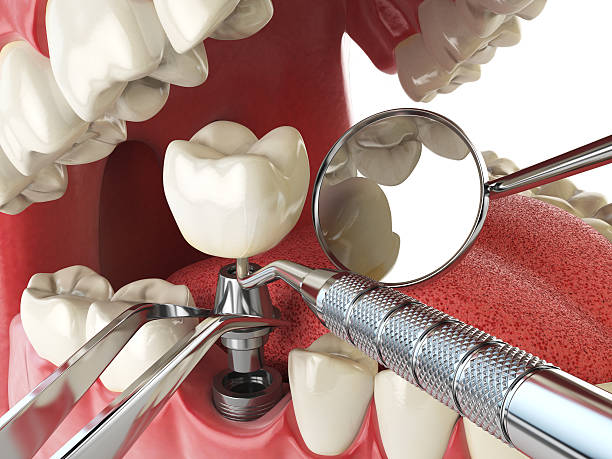 Best Chipped Tooth Repair Near Me  in Hayfork, CA